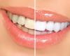 6 راه خانگی برای سفید کردن دندان