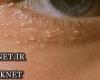 علت بروز و درمان دانه‌های چربی سفید رنگ زیر چشم 