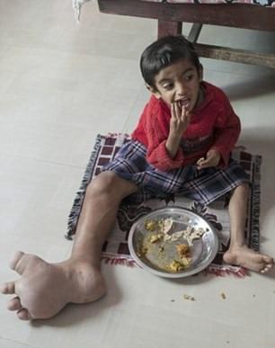 بیماری عجیب پسر چهار ساله هندی (تصاویر)