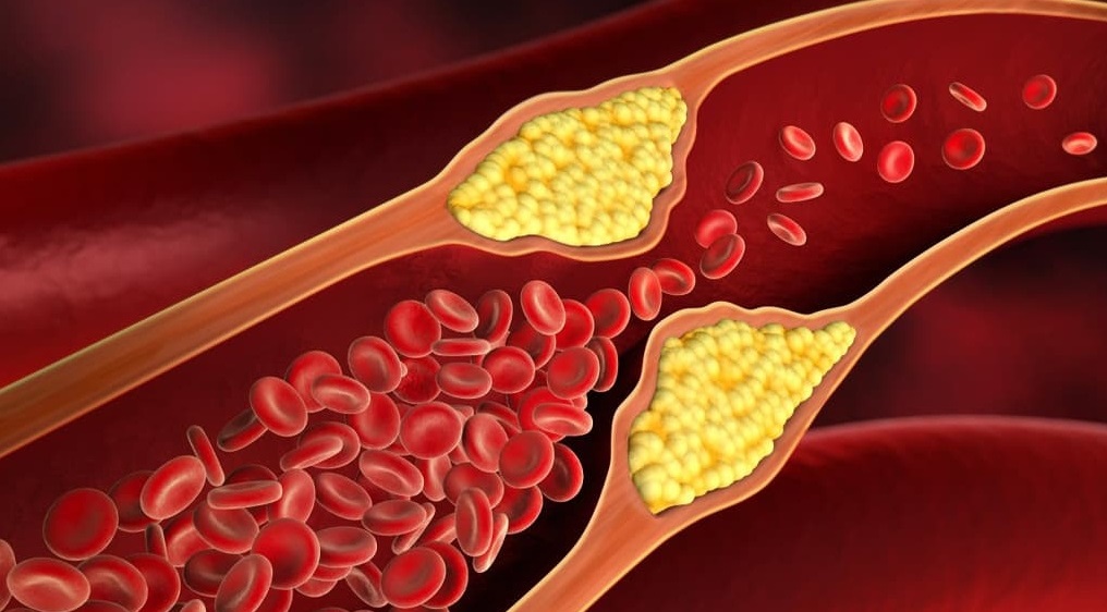 علائمی که نشان از چربی خون بالاست