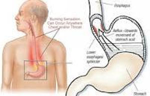 رفلاکس معده به مری 