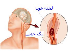 عواملی که باعث بهبود سکته مغزی می شود