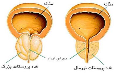 آشنایی با نشانه ها وعلایم سرطان پروستات