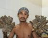 (عکس) مرد درختی بنگلادشی جراحی شد