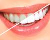 سفیدکننده های خانگی برای سفید کردن دندان‌ها در نوروز 