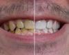 علت تیره شدن دندان