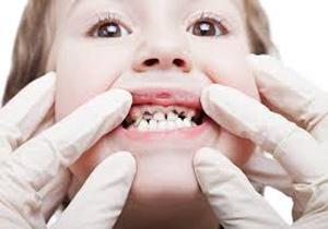 حکایت قطره‌ای که دندان کودک را سیاه می‌کند 
