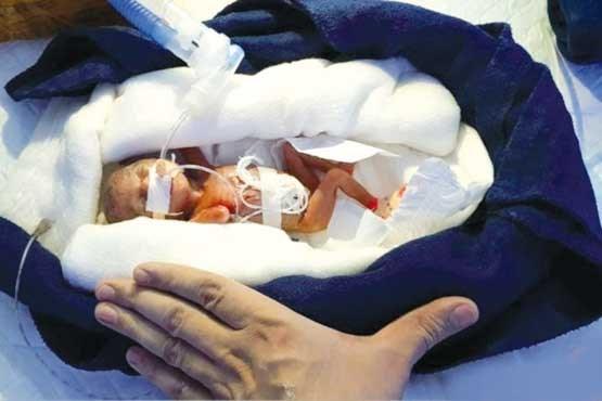 کم وزن‌ترین نوزاد جهان + عکس