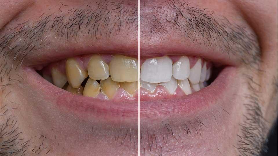 علت تیره شدن دندان
